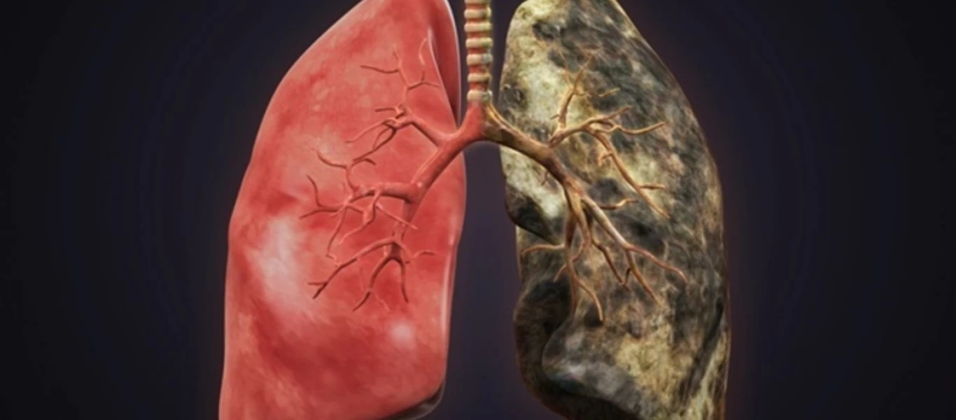 Δείτε πως είναι οι πνεύμονες ενός χρόνιου καπνιστή (βίντεο)